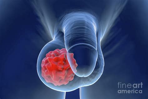 Testicular Cancer Photograph By Kateryna Kon Science Photo Library Fine Art America
