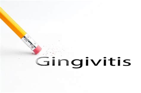 How To Cure Gingivitis 753x500 D Dental