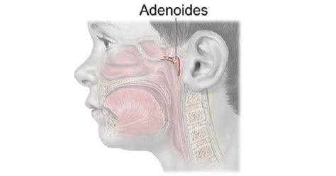 Tratamiento Natural Para La Adenoiditis Encuentos