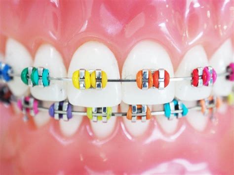 what exactly are rubber bands used for with braces shirck orthodontics ohio orthodontists