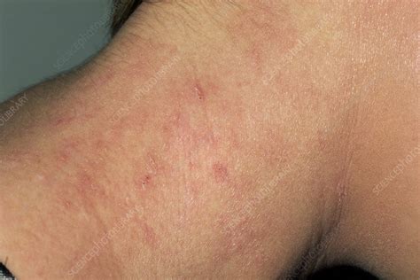 Eczema Following Treatment Stock Image M1500256 Science Photo