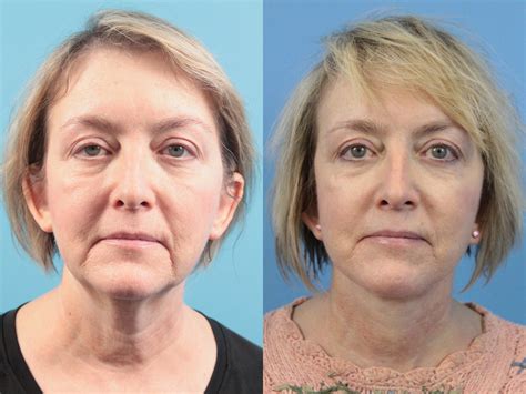 Facelift Before And After Pictures Case 124 West Des Moines Ia
