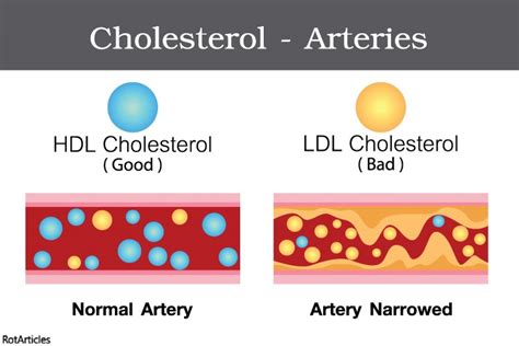 Good And Bad Cholesterol Hdl Vs Ldl Madmedics