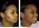 Photos of Laser Treatment For Acne Scars On Black Skin