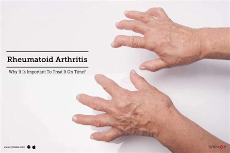 Rheumatoid Arthritis Why It Is Important To Treat It On Time By Dr
