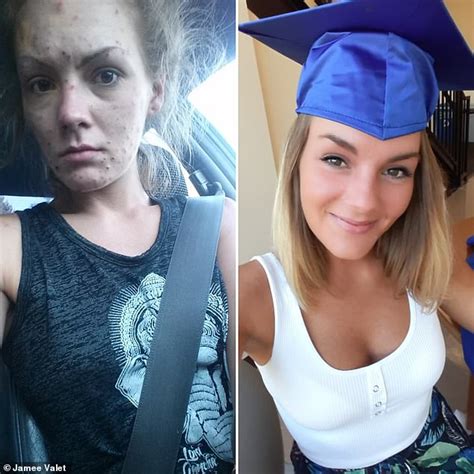Incredible Before And After Pictures Show How Pock Marked Meth Addict Turned Her Life Around