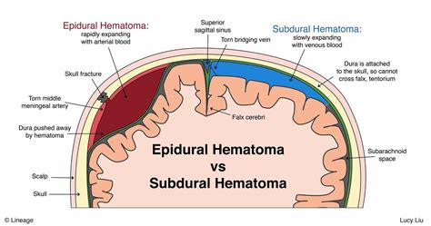 Epidural Hematoma STEP2 3 Neurology Step 2 3 Medbullets Com