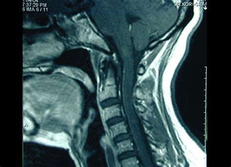 Cervical Spinal Stenosis Dr Dan Heffez Neurological Surgeon
