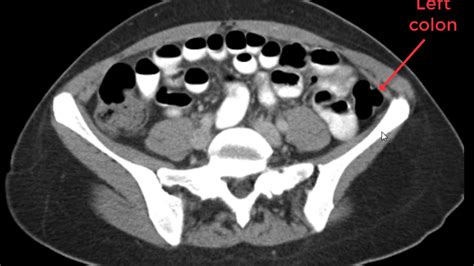Abdomen And Pelvis Ct Search Pattern In 5 Minutes Youtube