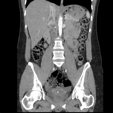 Normal Ct Abdomen And Pelvis Triphasic Protocol Image