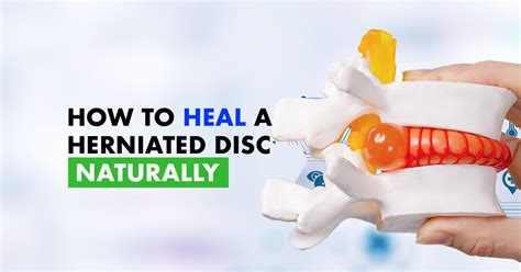 How To Heal A Herniated Disc Naturally The Health Smith