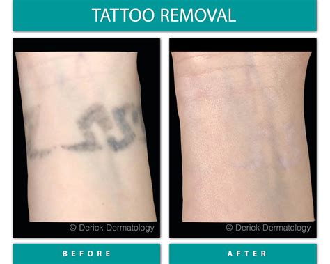 Tattoo Removal Laser Chicago Picosure Derick Dermatology