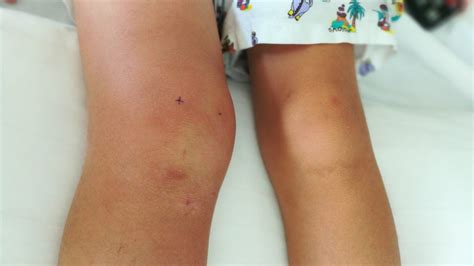Swollen Knee Causes Treatments And Home Remedies