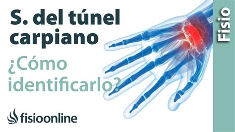 Cómo Saber Si Tienes El Síndrome Del Túnel Carpiano Youtube