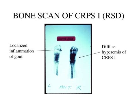 Crps I Rsd With Pictures Differential Diagnosis