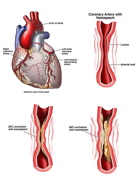 This results in coronary heart disease, the most common type of heart disease in the united states. Coronary Heart Disease | NHLBI, NIH