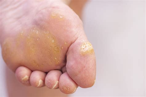 Warts On Your Feet Symptoms And Causes Of Plantar Warts Foot And Ankle