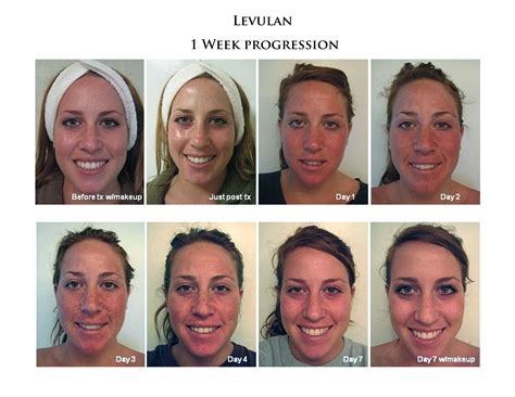 Photodynamic Therapy Acne Treatment | San Diego, CA | CLDerm