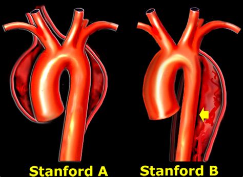 Acute Aortic Syndrome And Blunt Traumatic Aortic Injury Pictorial