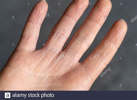 Itching Skin High Resolution Stock Photography And Images Alamy