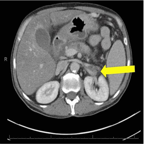 Cureus Splenic Vein Thrombosis A Case Series Of Consequential