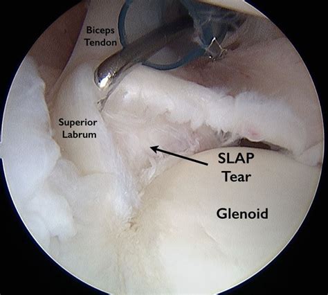 Labral Tears Of The Shoulder Anatomy And Causes Jeffrey H Berg M