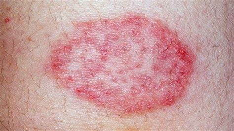 Leukemia Rash Pictures Signs And Symptoms