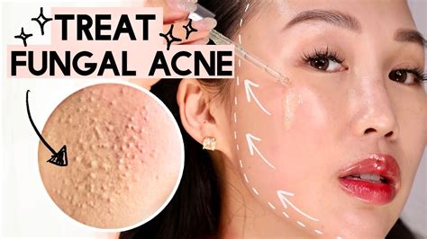 How To Get Rid Of Acne Textured Skin Rid Of Bumps 😡 Korean Skincare