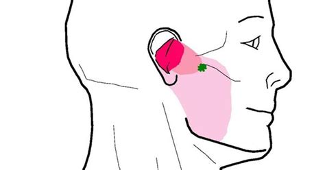 Understanding Trigger Points Earache With Jaw Tension Reflexology