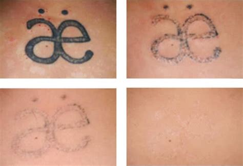 The Laser Tattoo Removal Healing Process Andrea Catton Laser Clinic