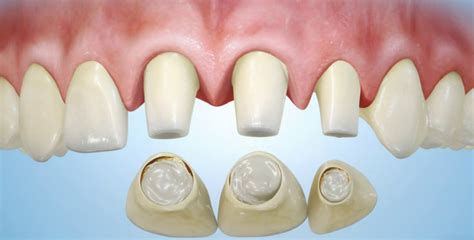 How Long Does It Take For Porcelain Veneers To Recover