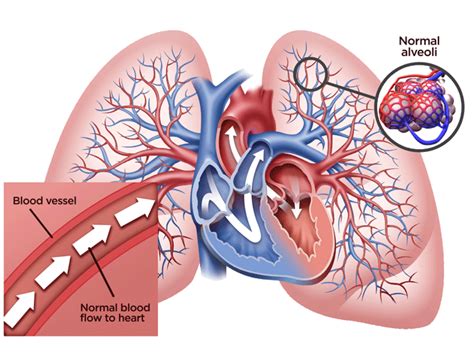 Hypoxic Respiratory Failure Hrf Associated With Pulmonary