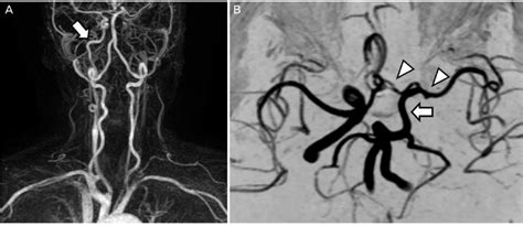 Magnetic Resonance Angiography Mra A Mra Reveals The Right