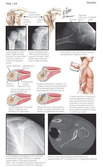 Posterior Dislocation Of Glenohumeral Joint Posterior Dislocations