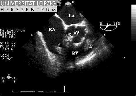 Right Ventricular Outflow View