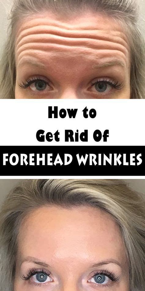 Pin On Foreheadwrinkles