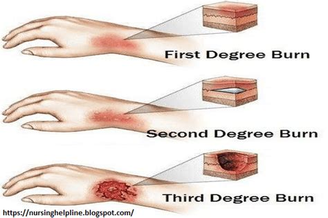 Briefly touching a hot pot, for example, would give you a first first degree burns are the least severe kind of burns. How to treat 2nd degree burns at home - MISHKANET.COM