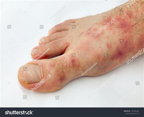 Close Males Foot Toes Red Rash Stock Photo 1747586381 Shutterstock