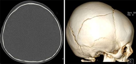 Pediatric Skull Fracture Diagnosis Should 3d Ct Reconstructions Be