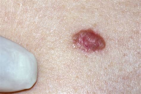 Understand How To Spot Skin Cancer Early The Bowman Institute