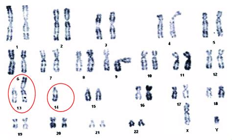Karyotype Of A Patient With Robertsonian Translocation 45 Xy Download Scientific Diagram