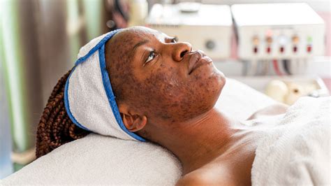 Hyperpigmentation In Darker Skin Tones Causes And Treatment Goodrx