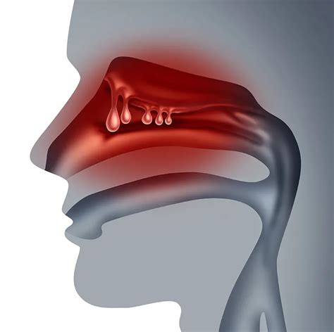 Nasal Polyps Tampa Fl Nasal And Sinus Services