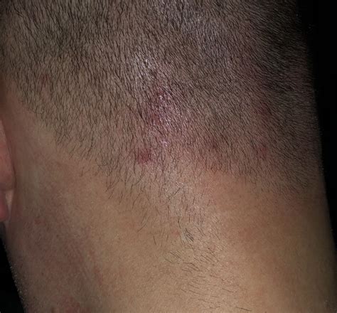 Scalp Acnefolliculitis Pictures Page 2 General Acne Discussion