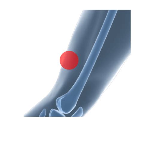 Iliotibial Band Syndrome River City Orthotics