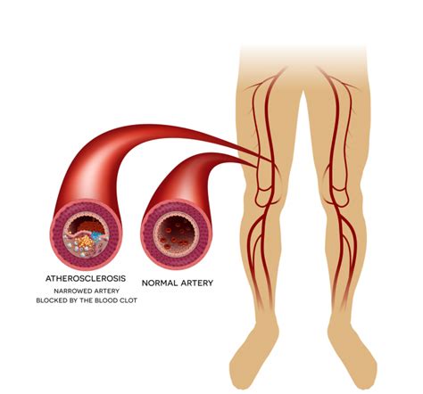 Peripheral Artery Disease Vivid Vascular Serving Miami And All Of South Florida