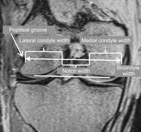 T1 Coronal View Of Knee Magnetic Resonance Imaging A Line Is Shown