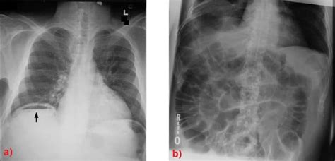 Gastrointestinal Perforation Aetiology Management Teachmesurgery