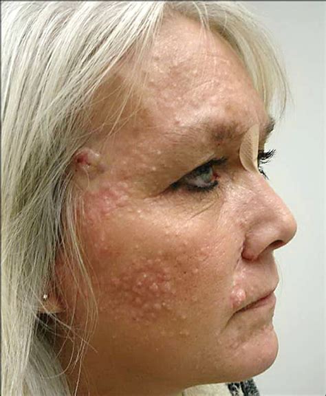 Albums 93 Pictures Photos Of Skin Conditions In Elderly Excellent