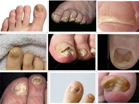Is This Toenail Fungus Find Out Here Eltham Foot Clinic